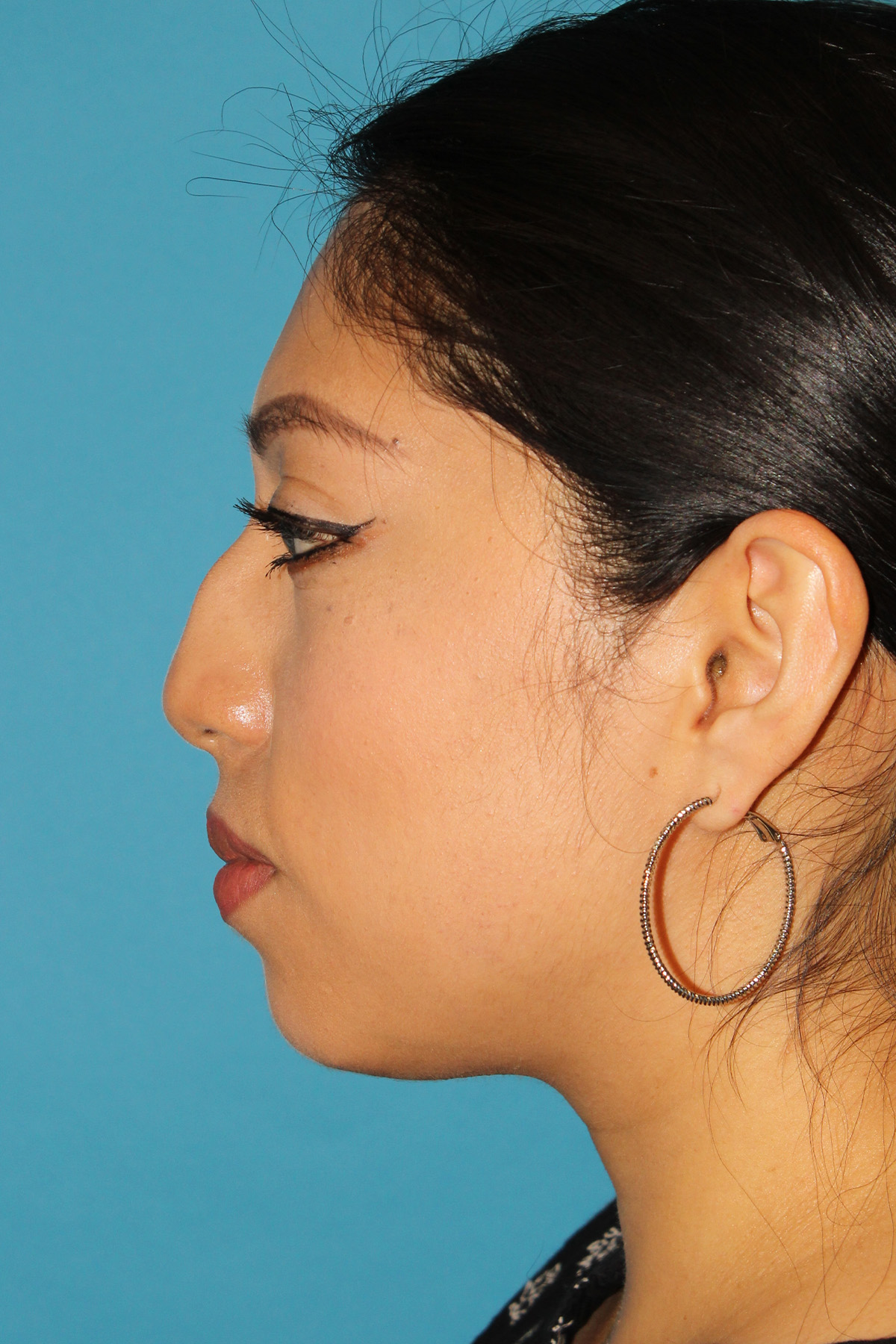 Chin Implant Before & After Patient #1670
