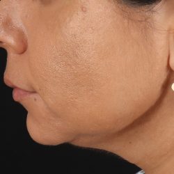 Facelift Before & After Patient #3555