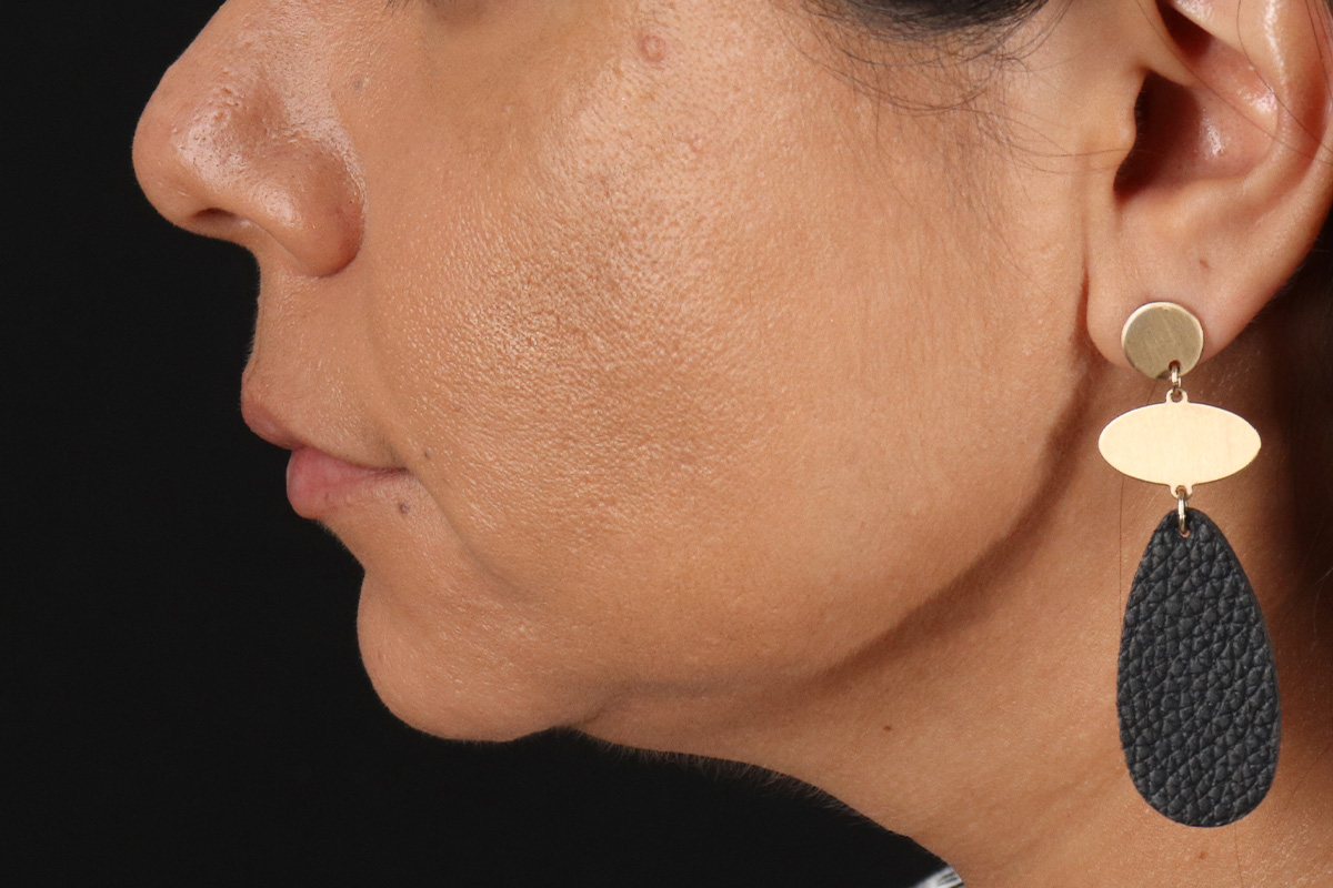 Facelift Before & After Patient #3555