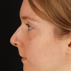 Rhinoplasty Before & After Patient #3280