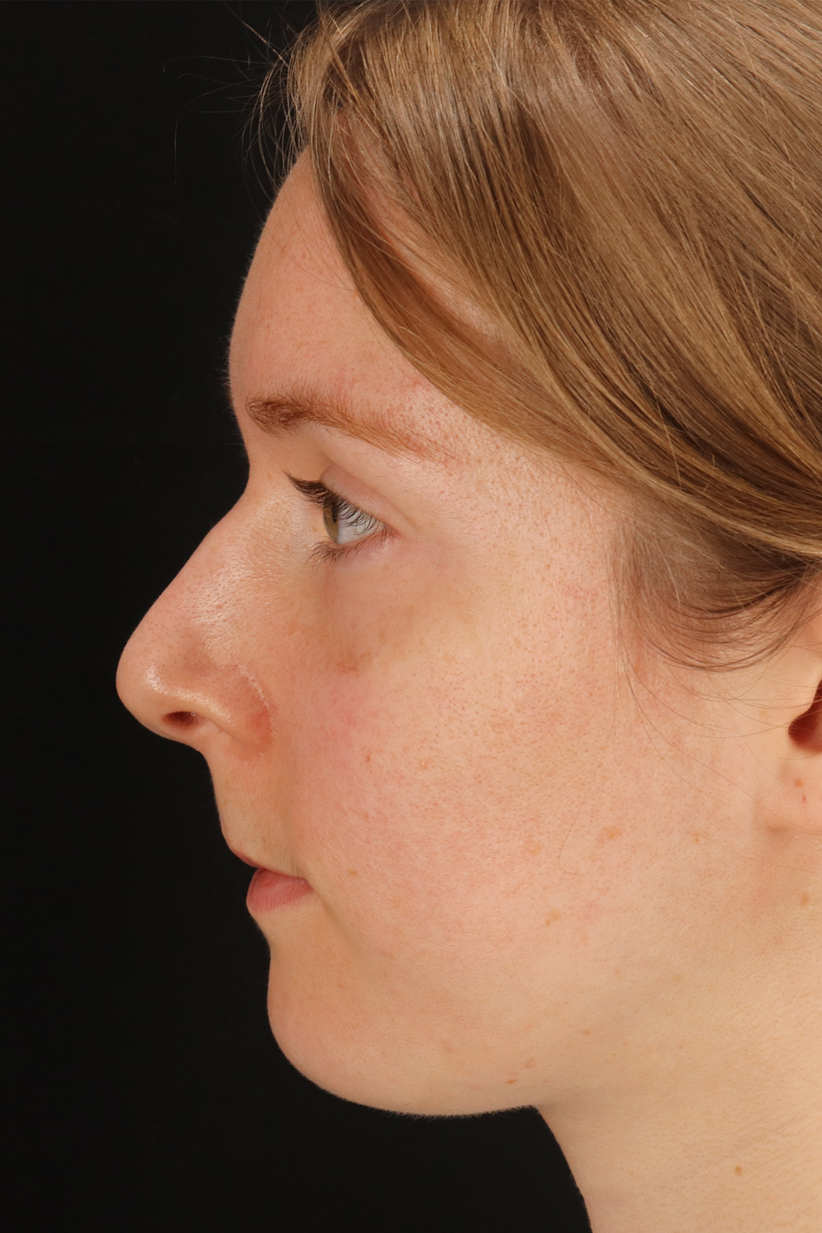 Rhinoplasty Before & After Patient #3280