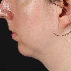 Chin Implant Before & After Patient #1562