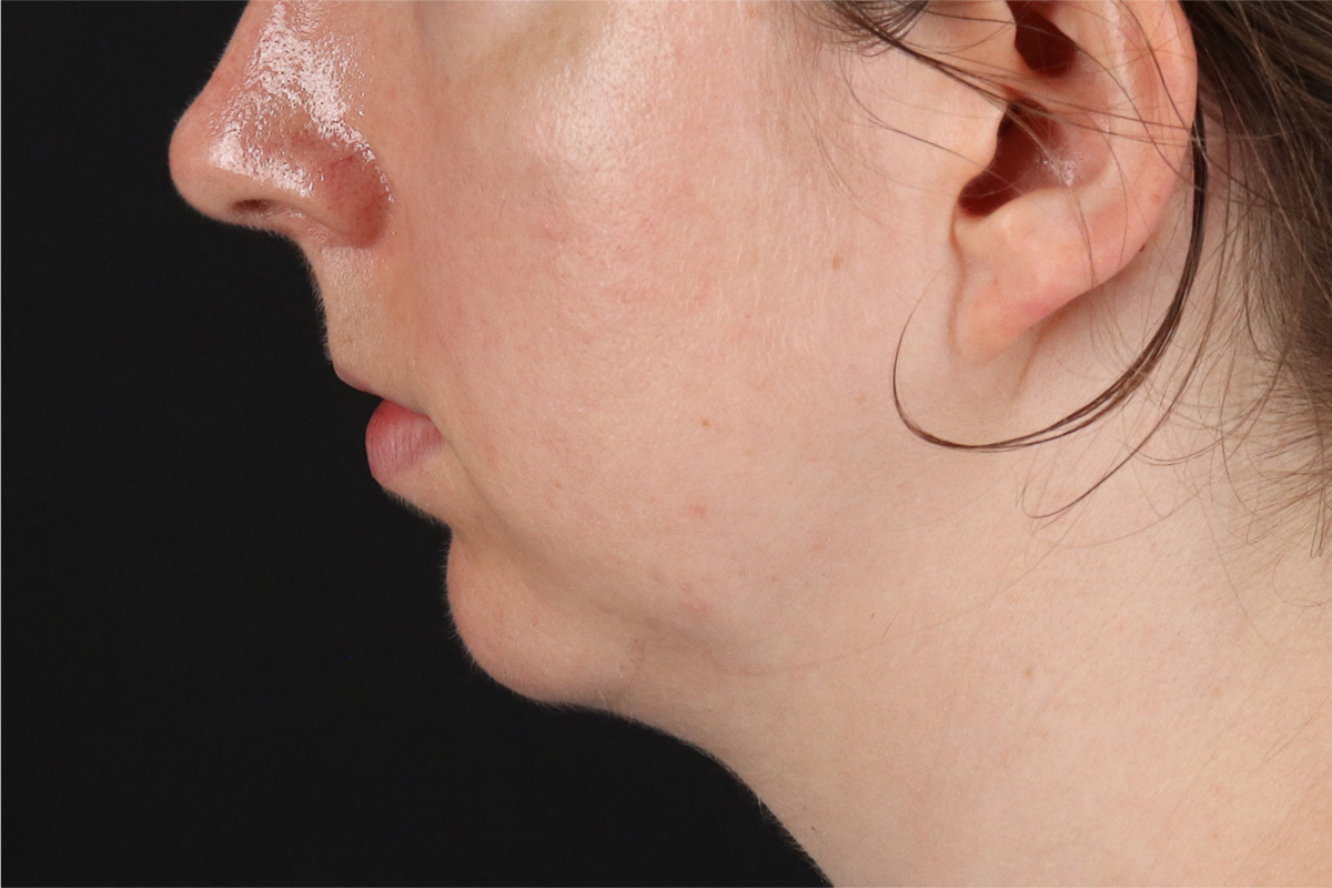 Chin Implant Before & After Patient #1562