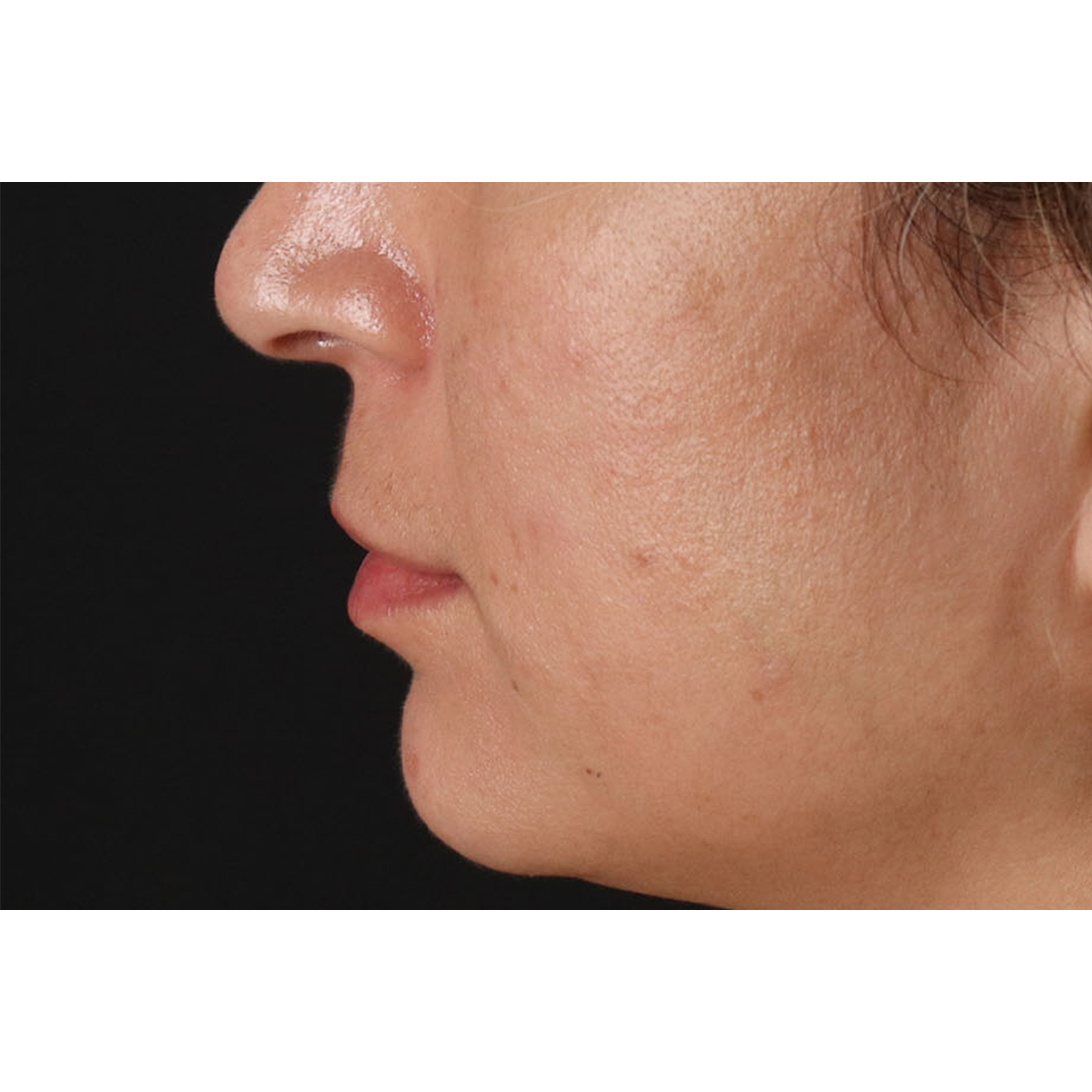 Lip Lift Before & After Patient #2166