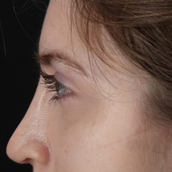 Browlift Before & After Patient #1319