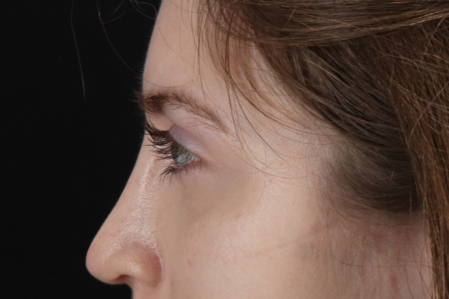 Browlift Before & After Patient #1319