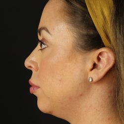 Chin Implant Before & After Patient #1518