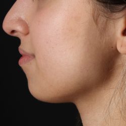 Chin Implant Before & After Patient #1573