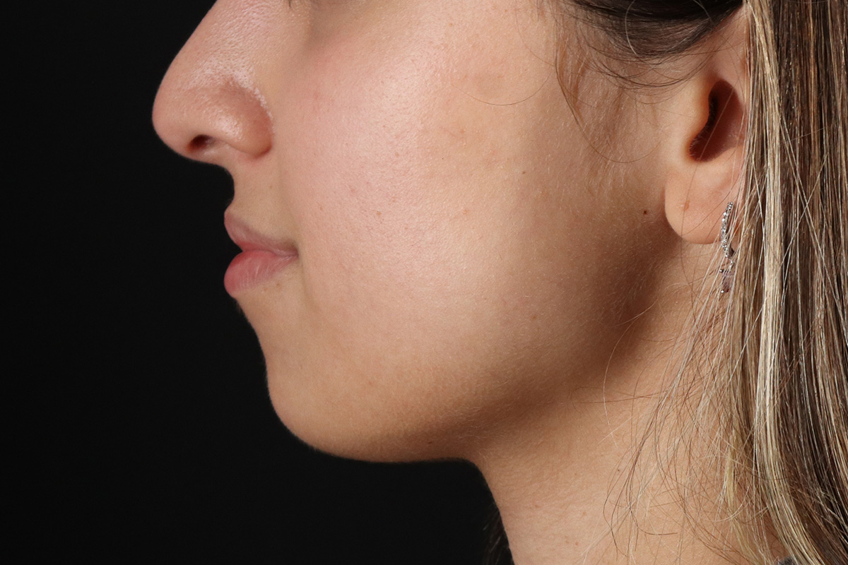 Chin Implant Before & After Patient #1573