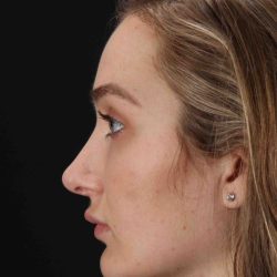Browlift Before & After Patient #1297