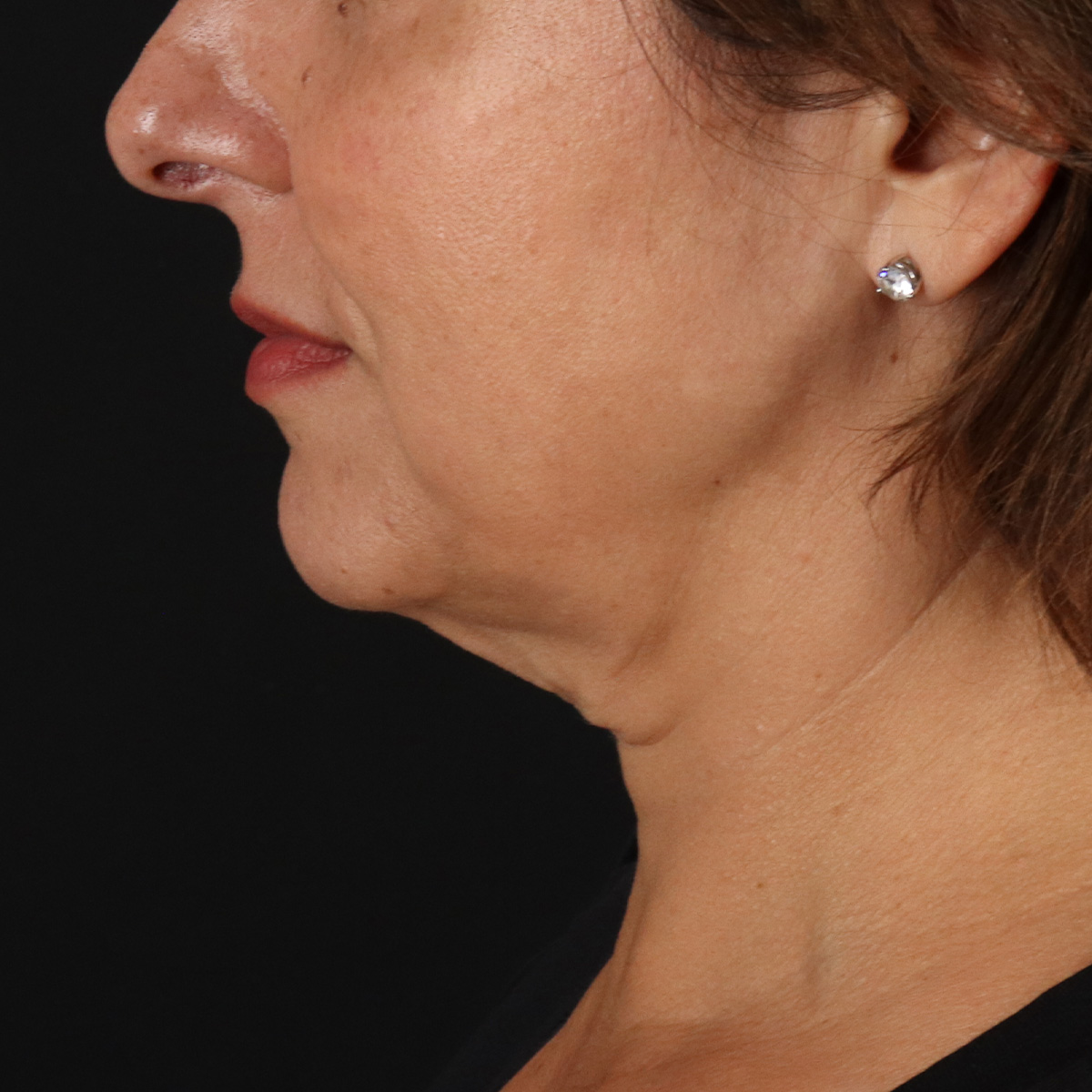 Neck Lift Before & After Patient #2472