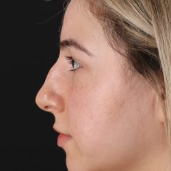 Rhinoplasty Before & After Patient #3247