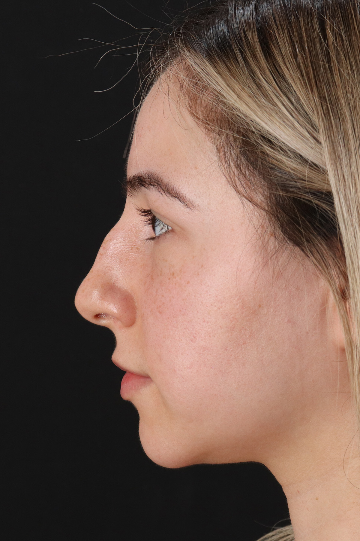 Rhinoplasty Before & After Patient #3247