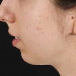 Chin Implant Before & After Patient #1551