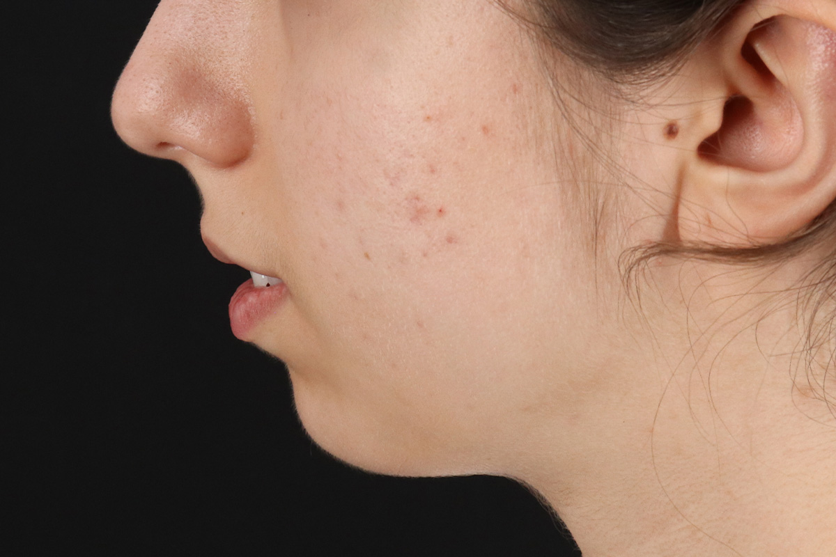 Chin Implant Before & After Patient #1551
