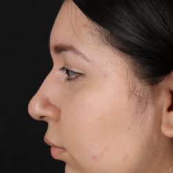 Chin Implant Before & After Patient #1604
