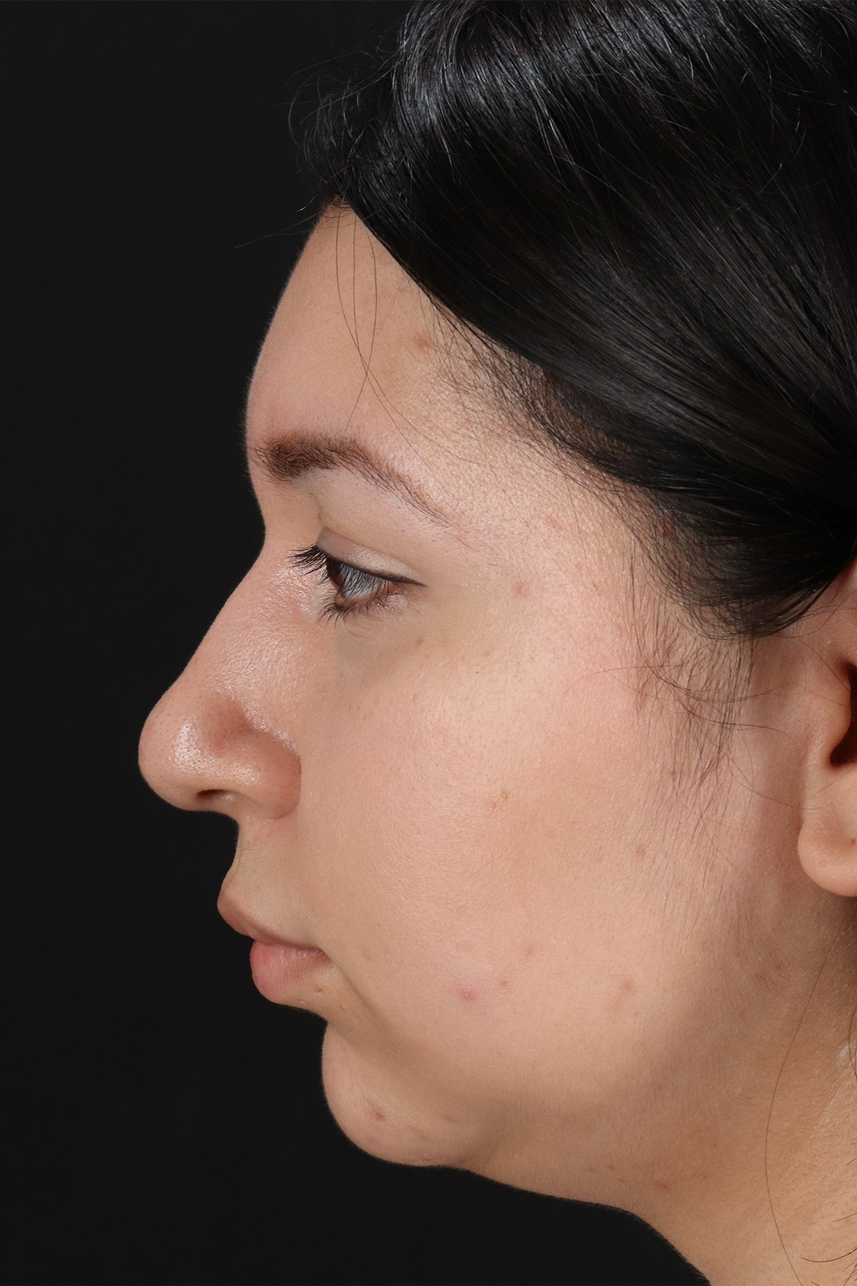 Chin Implant Before & After Patient #1604
