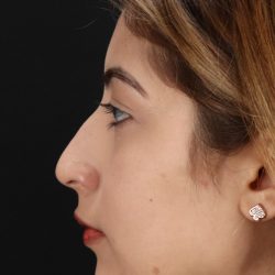 Liquid Rhinoplasty Before & After Patient #2254