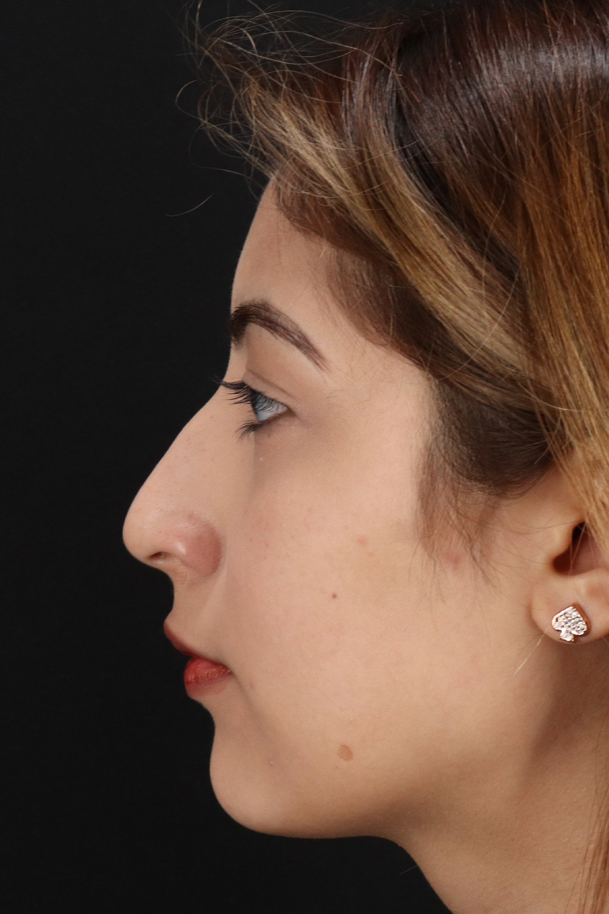 Liquid Rhinoplasty Before & After Patient #2254