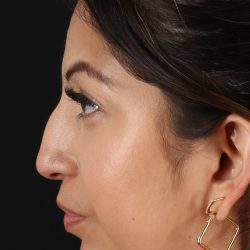Rhinoplasty Before & After Patient #3049