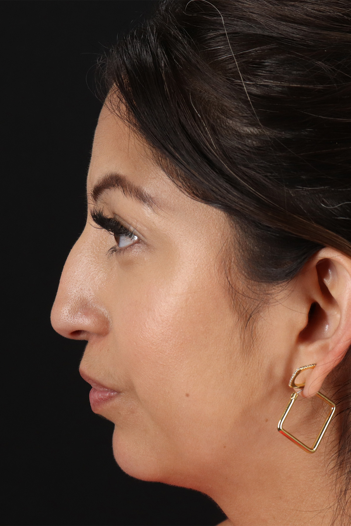 Rhinoplasty Before & After Patient #3049