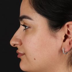 Rhinoplasty Before & After Patient #3071