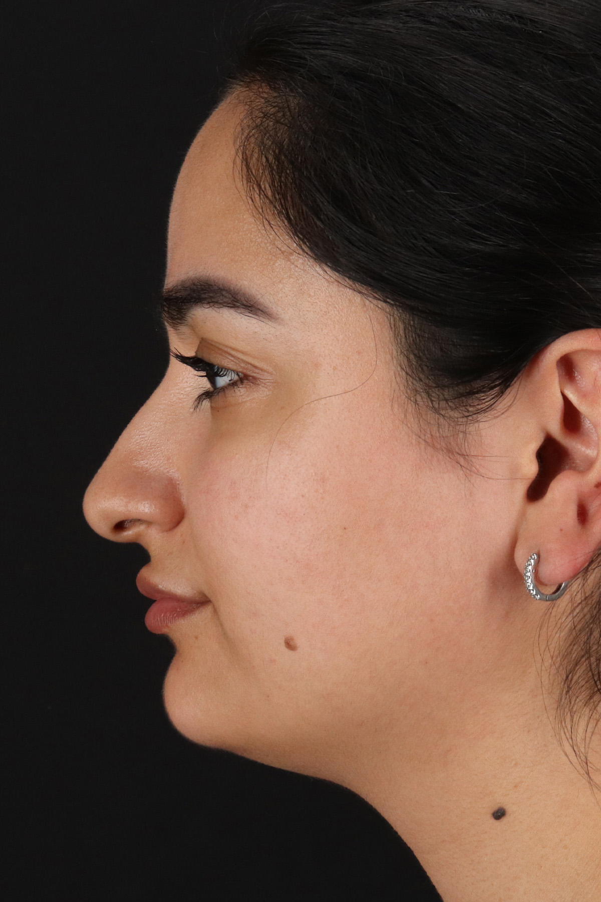 Rhinoplasty Before & After Patient #3071