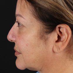 Neck Lift Before & After Patient #2593