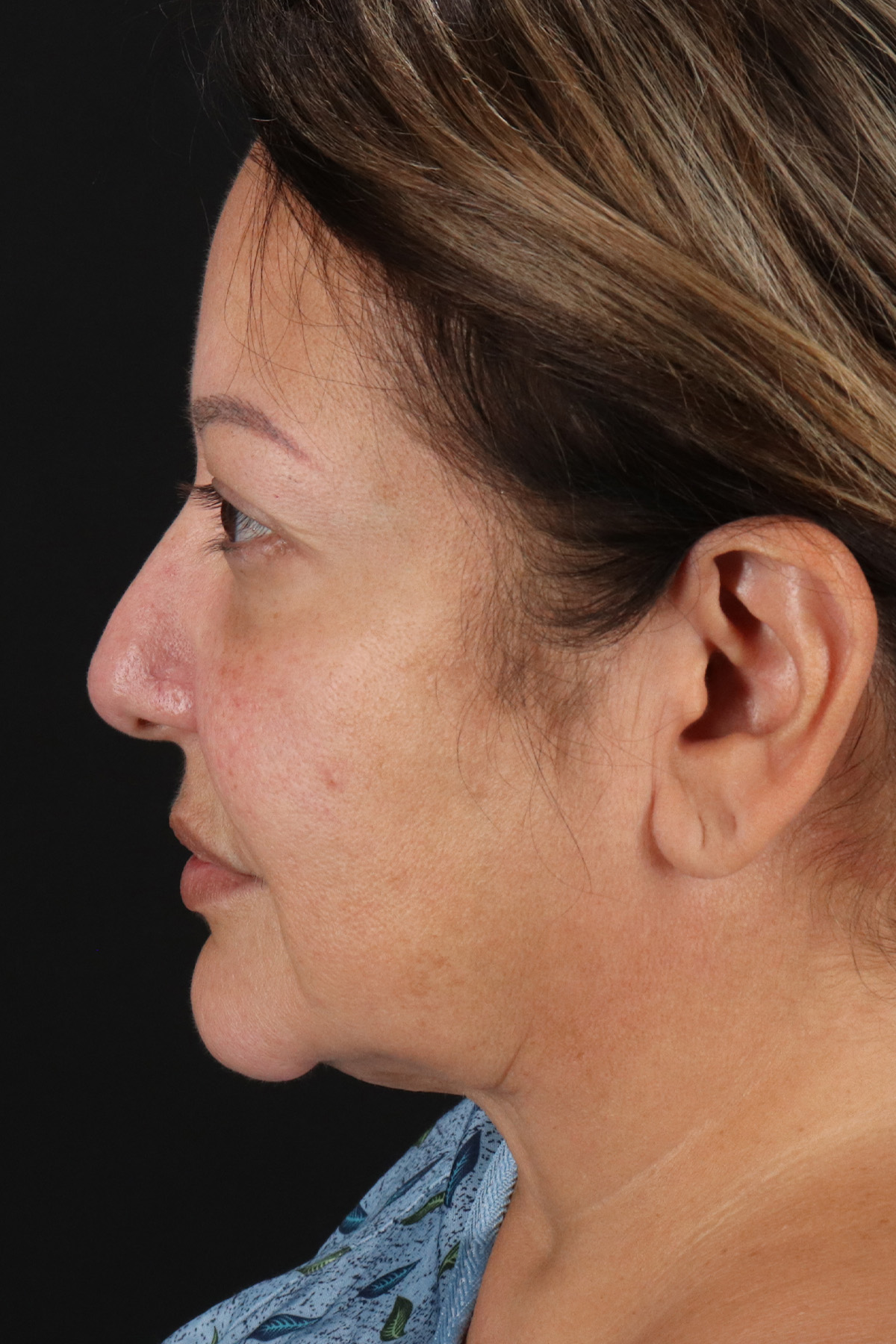 Facelift Before & After Patient #1888