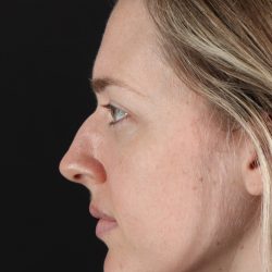 Rhinoplasty Before & After Patient #3291