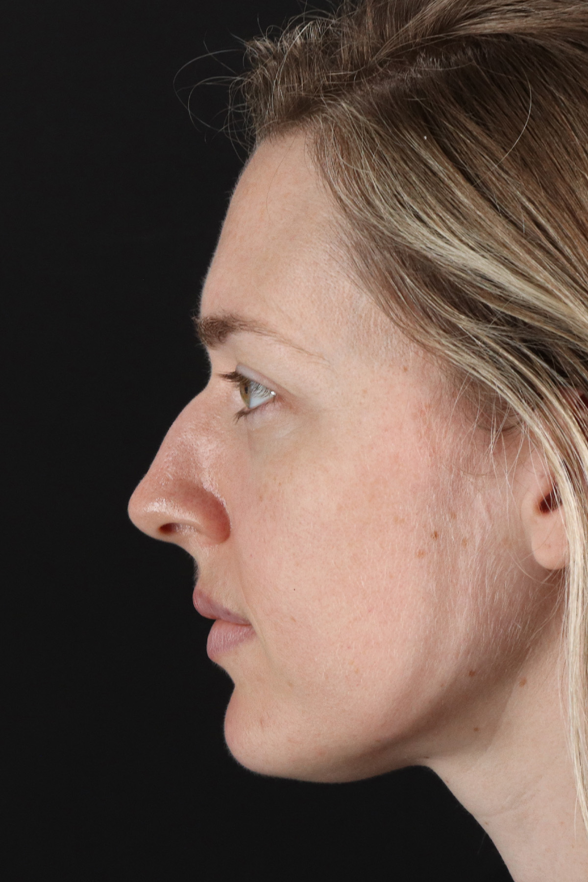 Rhinoplasty Before & After Patient #3291