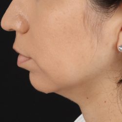 Chin Implant Before & After Patient #1540