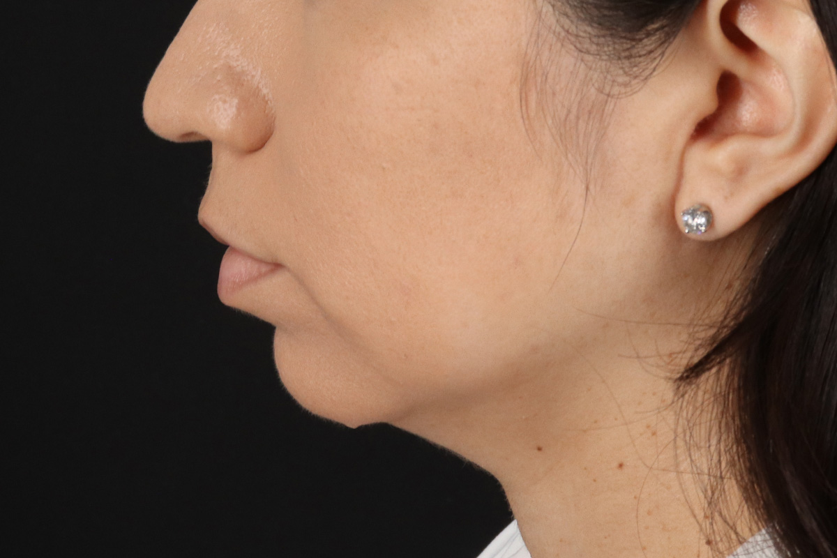 Chin Implant Before & After Patient #1540