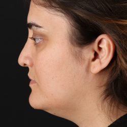 Neck Lift Before & After Patient #2560