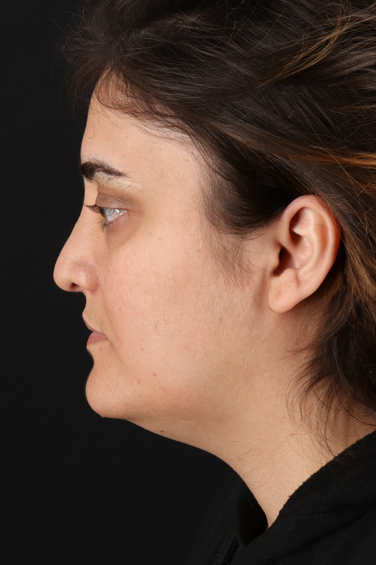 Neck Lift Before & After Patient #2560