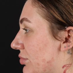 Rhinoplasty Before & After Patient #3104