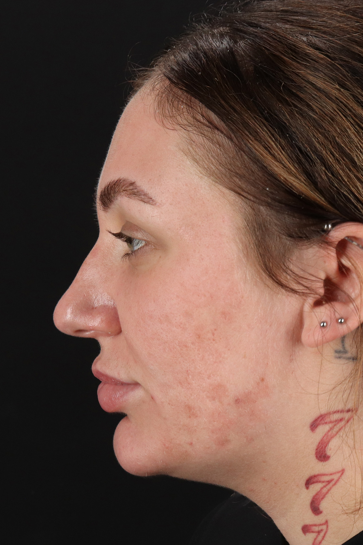 Rhinoplasty Before & After Patient #3104