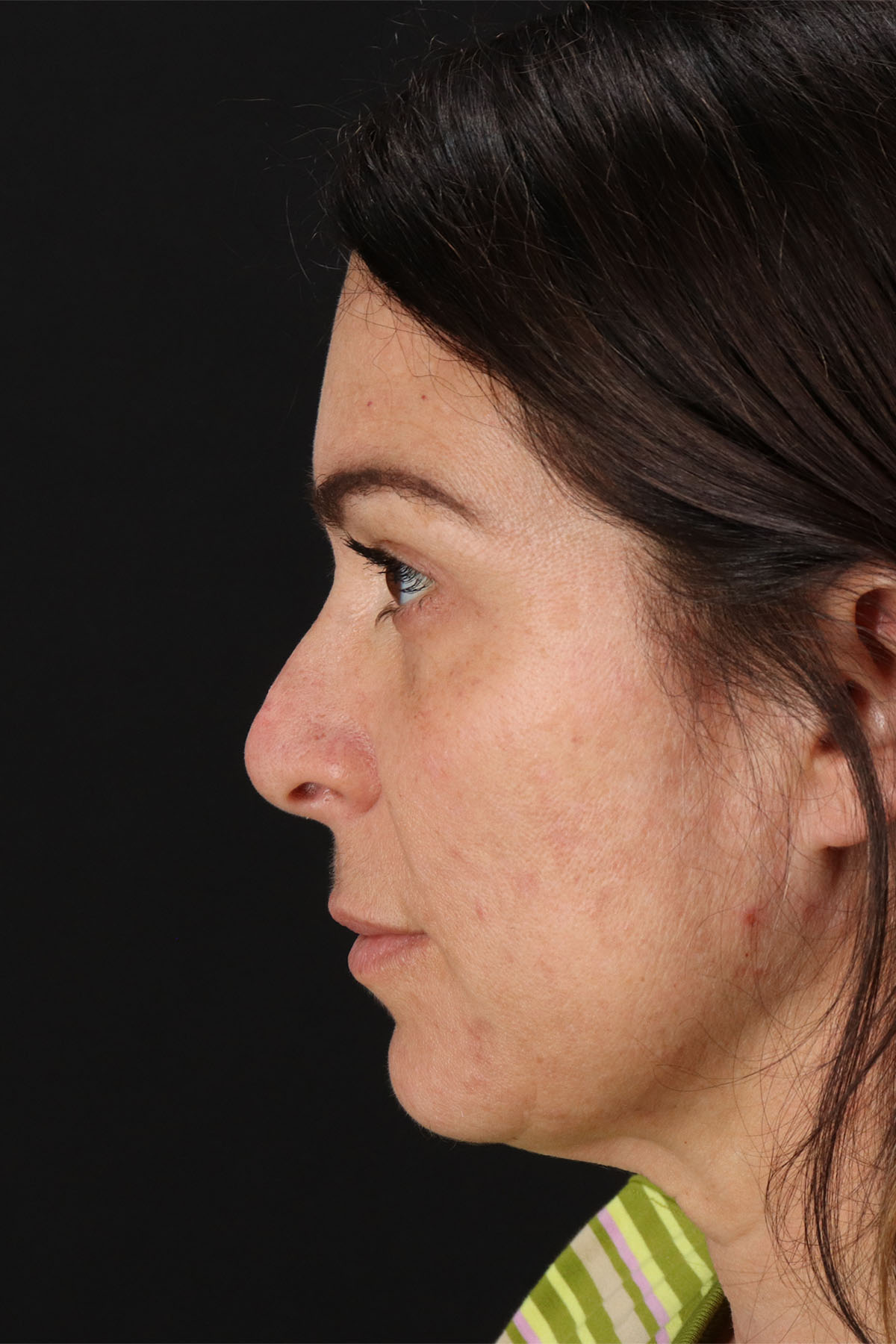 Lip Lift Before & After Patient #2133