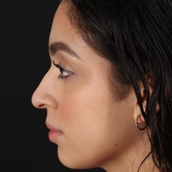 Rhinoplasty Before & After Patient #3269