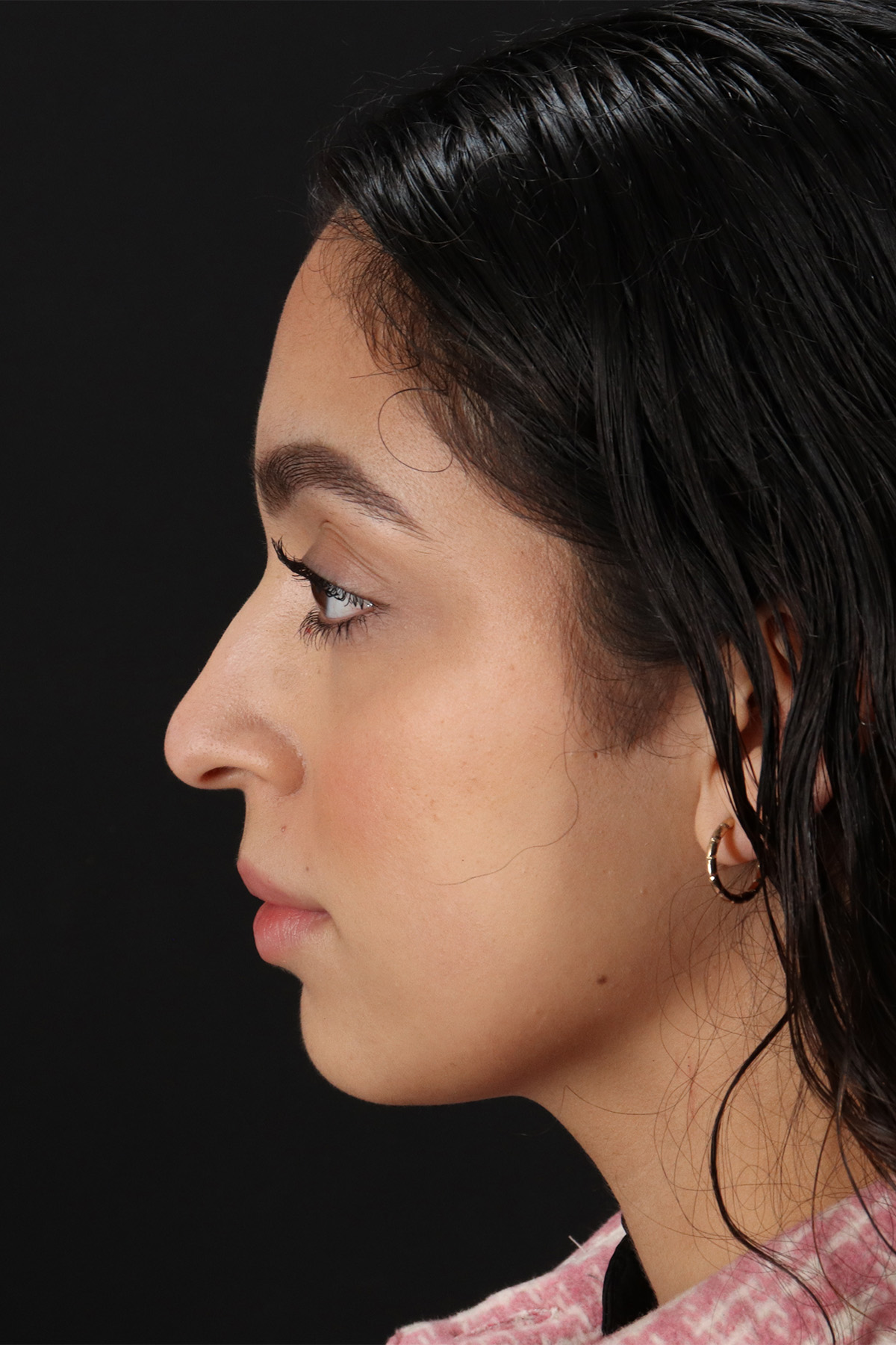 Rhinoplasty Before & After Patient #3269