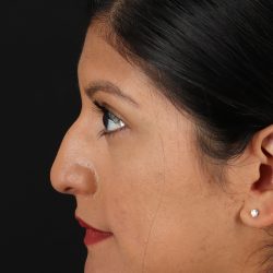 Rhinoplasty Before & After Patient #3181