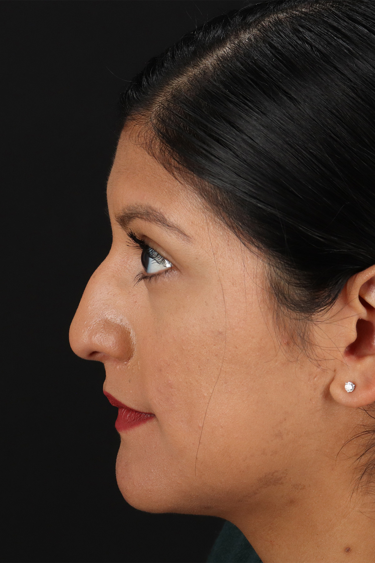 Rhinoplasty Before & After Patient #3181