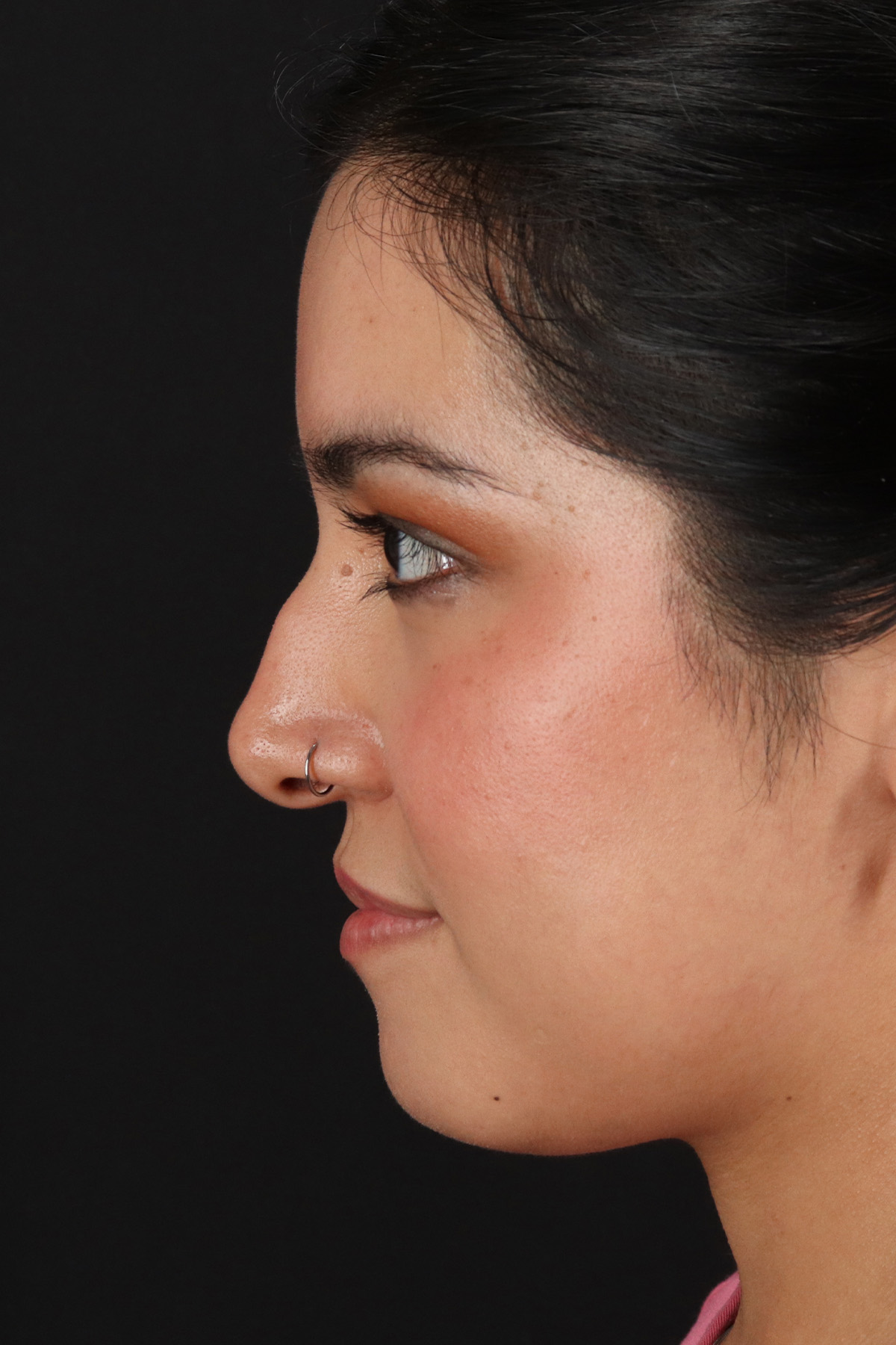 Fillers Before & After Patient #2041