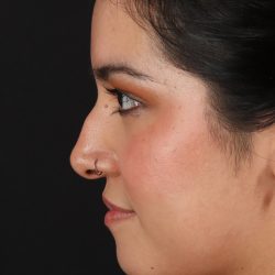 Liquid Rhinoplasty Before & After Patient #2265