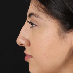 Rhinoplasty Before & After Patient #3214