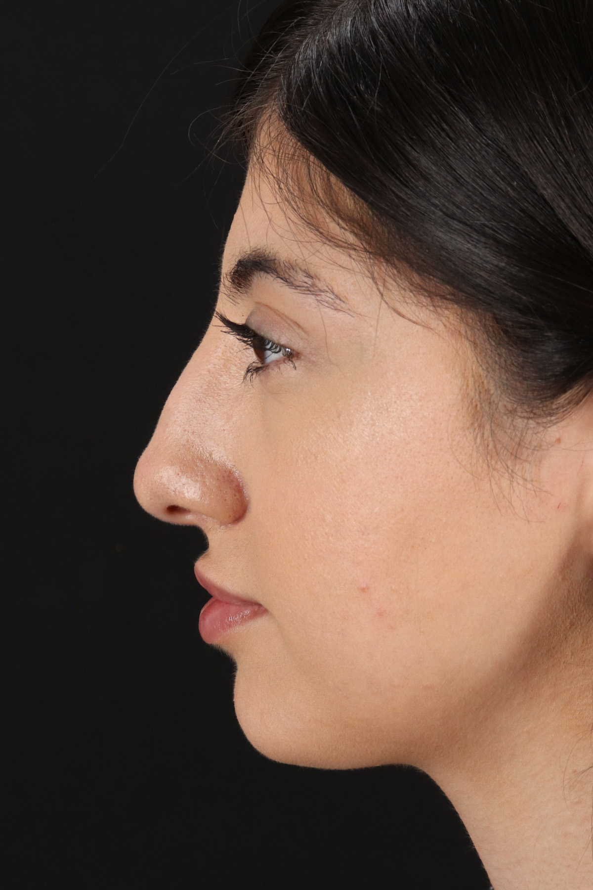 Rhinoplasty Before & After Patient #3214