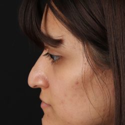 Rhinoplasty Before & After Patient #3038