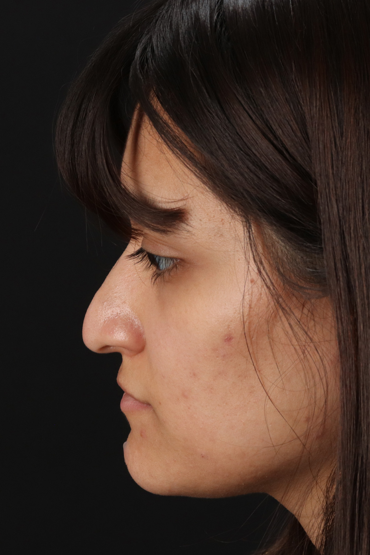 Rhinoplasty Before & After Patient #3038