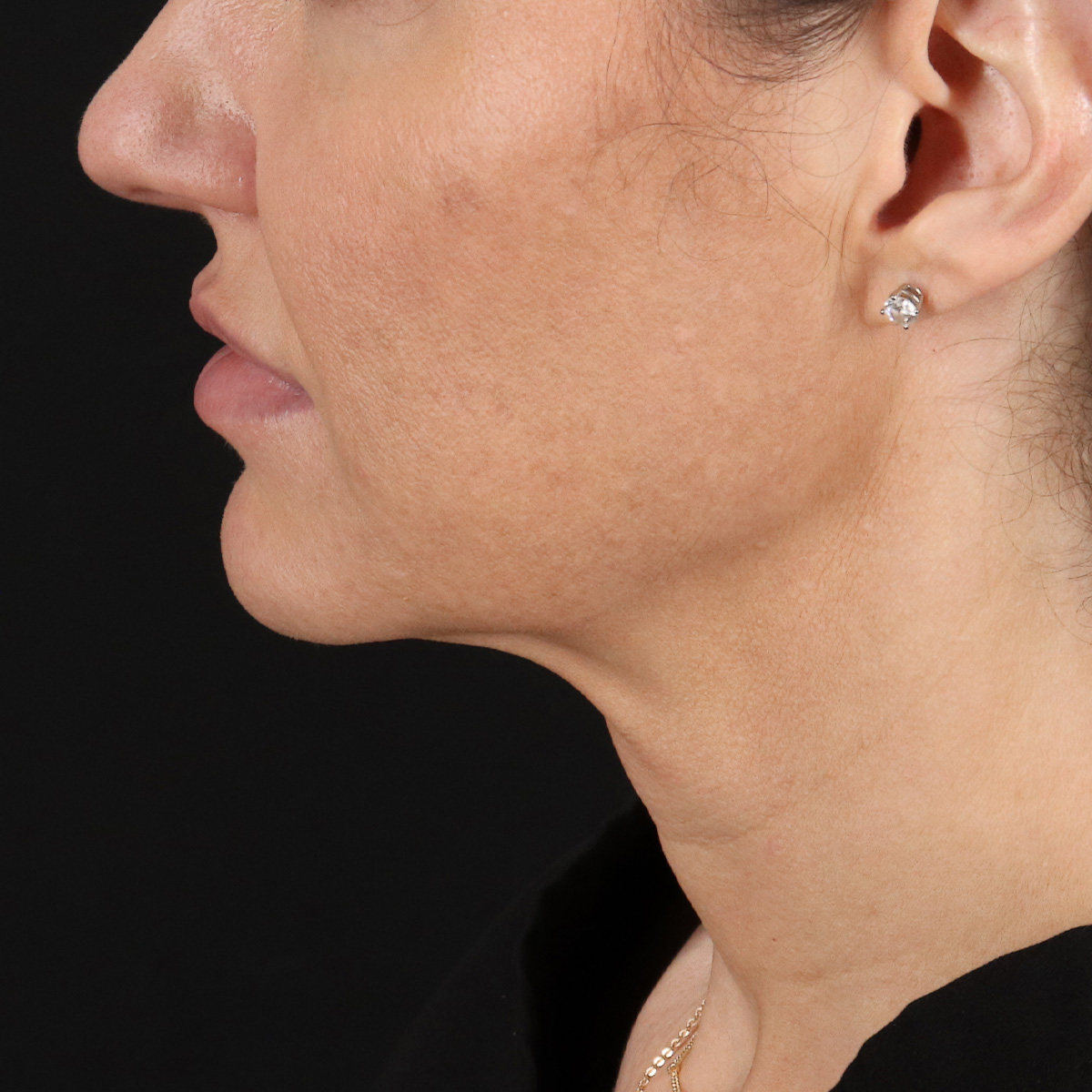 Facelift Before & After Patient #1921