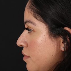 Fillers Before & After Patient #2063